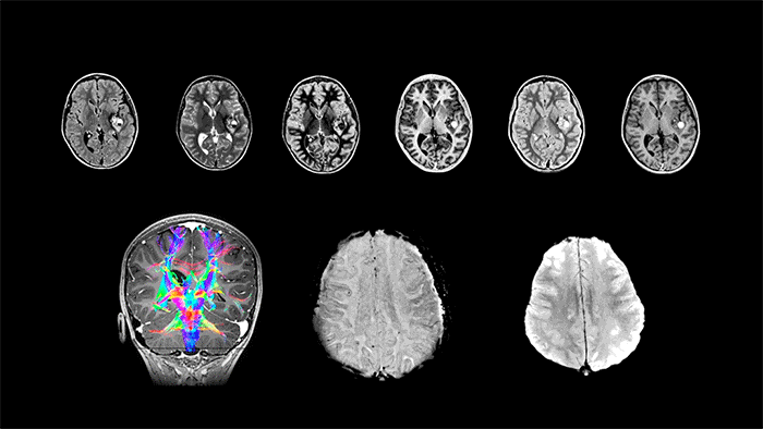 MRI is a modality with a multiple Contrasts