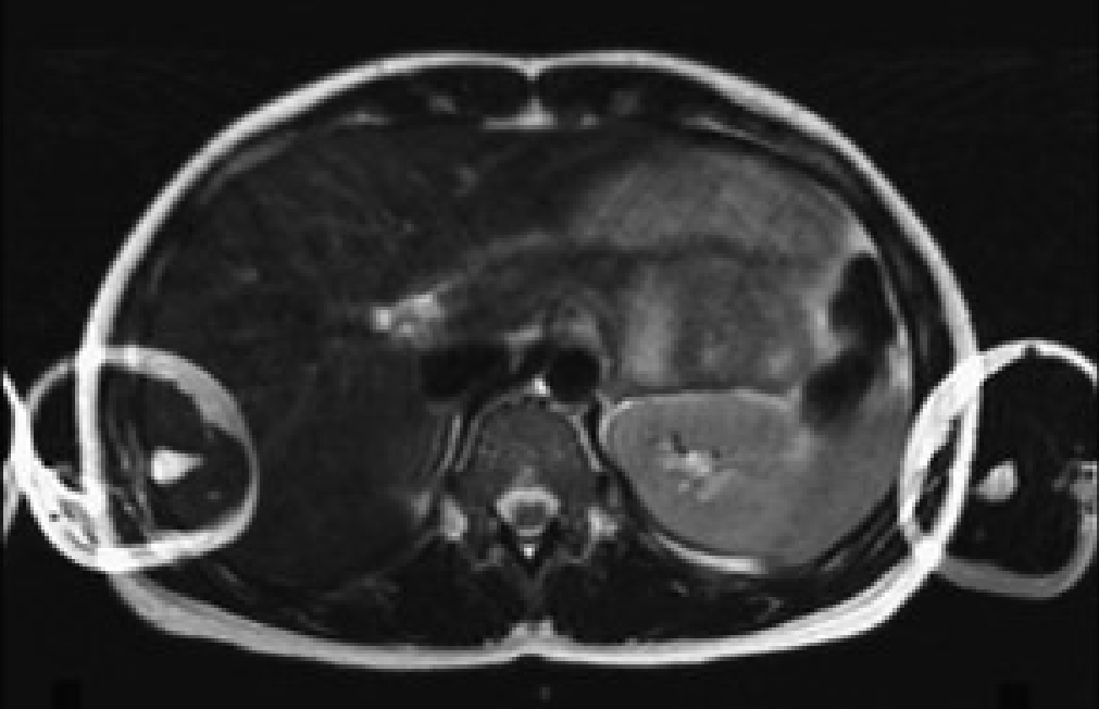 Axial abdomen image with aliasing