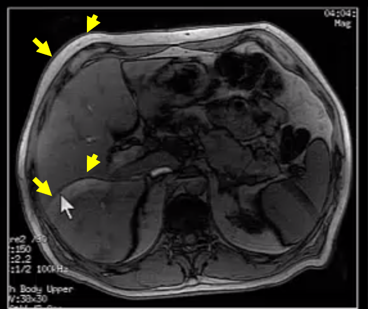 Axial abdomen image with unresolved aliasing with parallel imaging