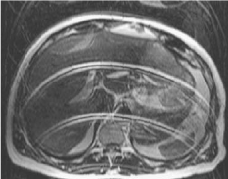 Axial abdomen image with motion