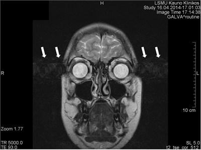 Coronal brain image with motion