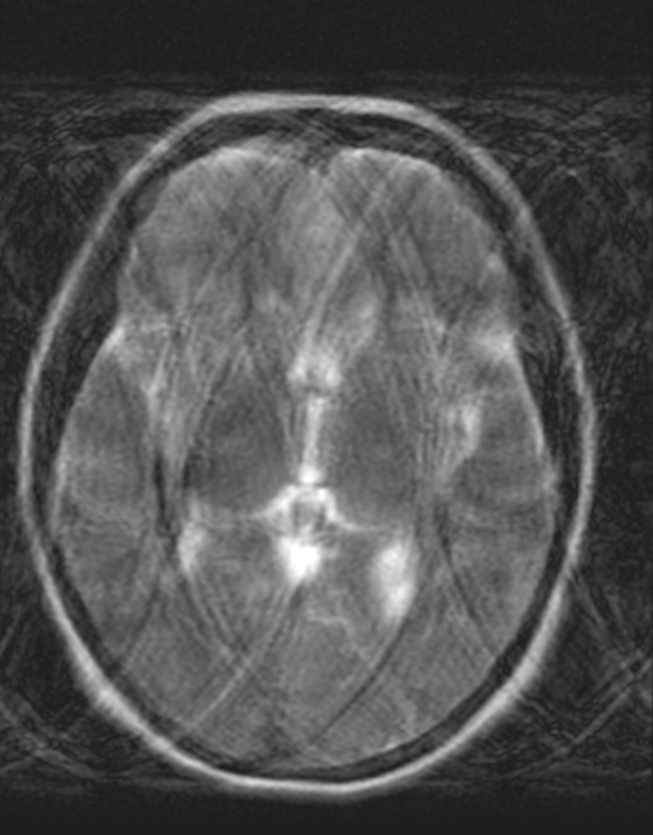 Axial brain image with motion