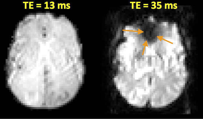 Axial brain image with T2* artifact