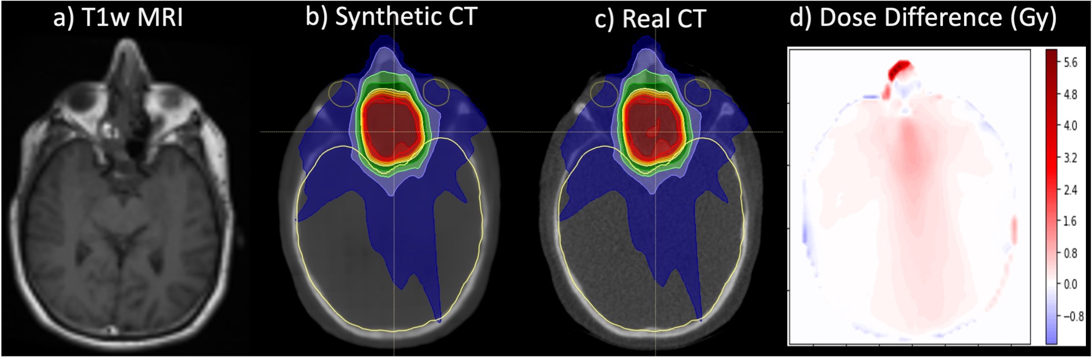 Synthesizing CT from MRI in Radiation Oncology